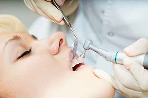 Rialto family dentist | teeth cleaning | Rialto Family Dental Center