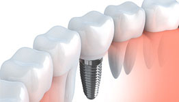 Dental Implants | Rialto Implant Dentist | Rialto Family Dental Center