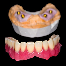 Dental Implants | Rialto Implant Dentist | Rialto Family Dental Center
