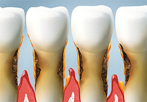 Rialto family dentist | gum disease treatment, bleeding gums| Rialto Family Dental Center