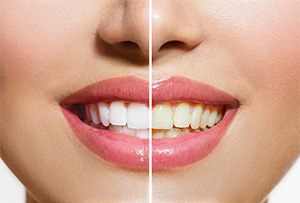 Rialto cosmetic dentist |teeth whitening | Rialto Family Dental Center